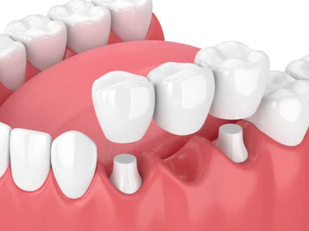 dental crown illustration