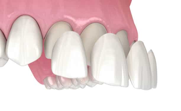 veneers construction