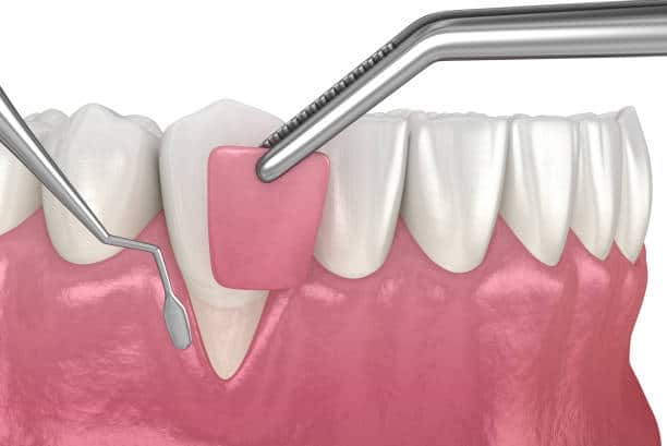 gum reshaping contouring surgery