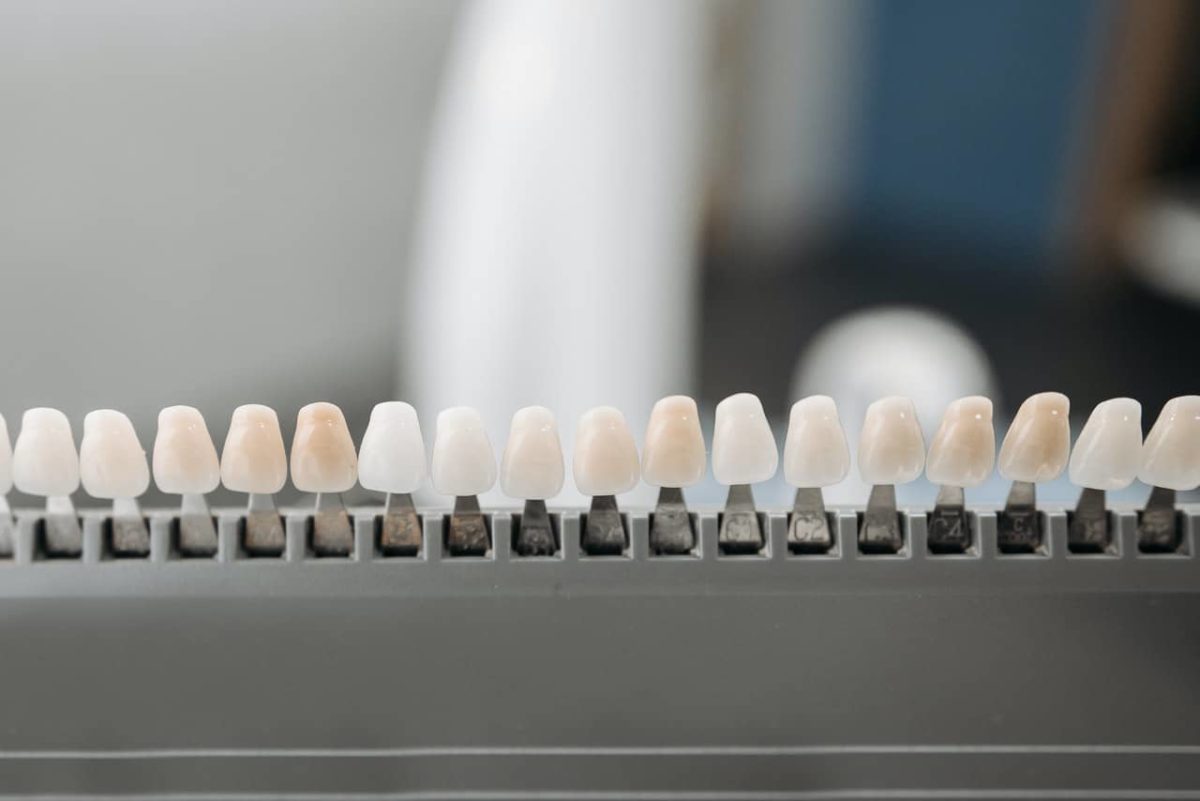 cosmetic teeth bonding