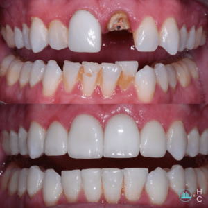 dead tooth root canal before and after