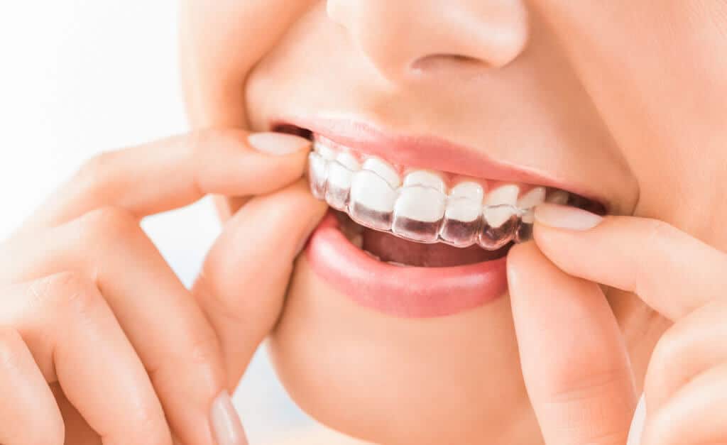 invisalign retainer after treatment