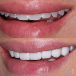Invisalign