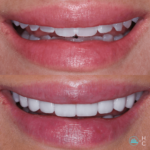 Veneers