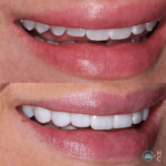 whiter teeth