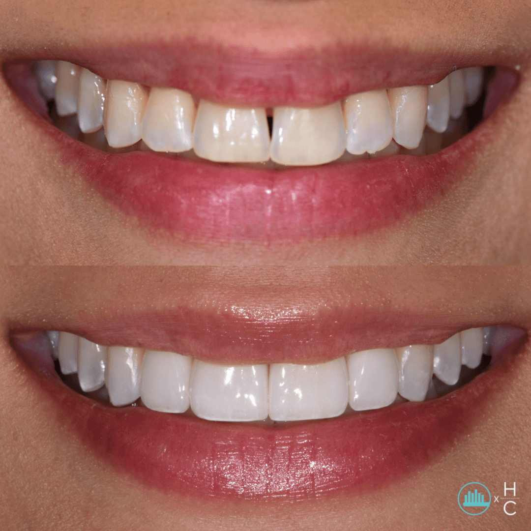 dental veneers