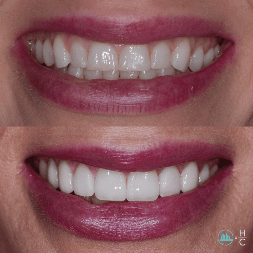 What Is Gingivectomy