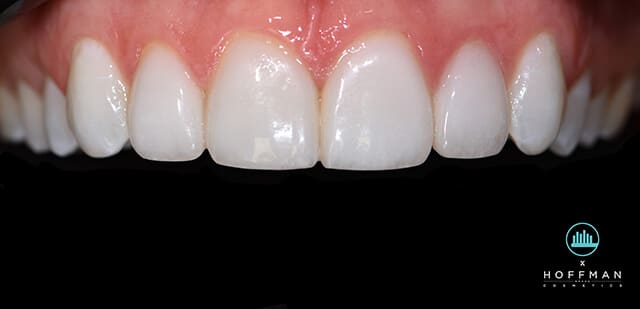 gingivitis surgery