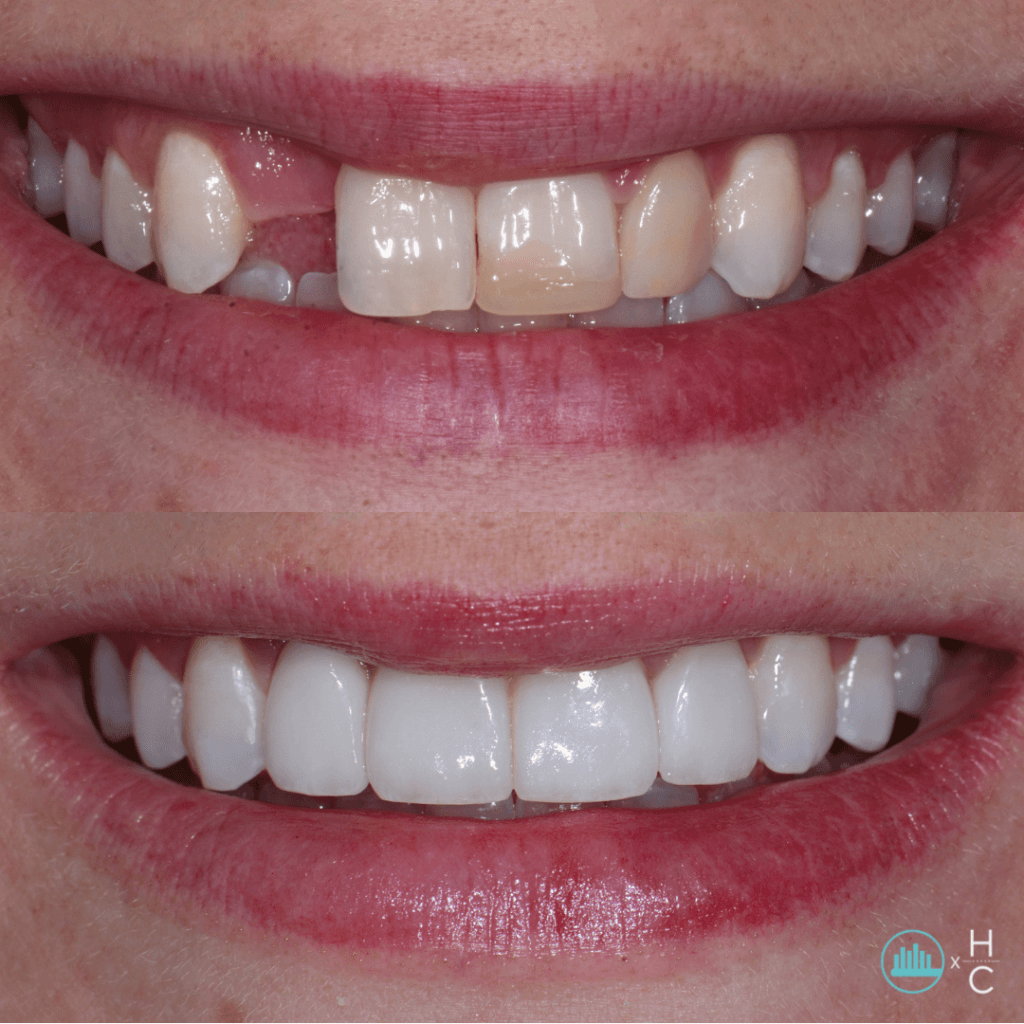 DENTAL IMPLANTS​