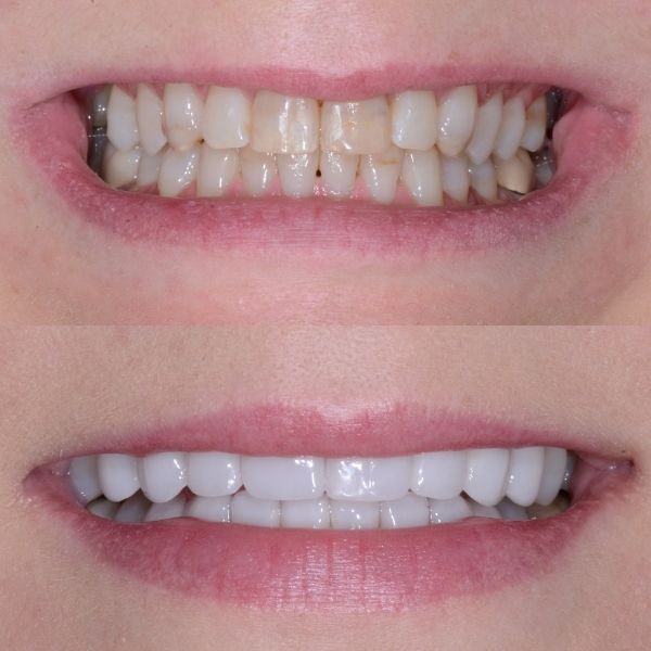 Full Mouth Rehab