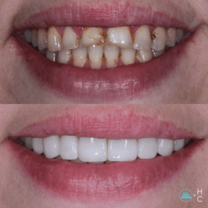 What Is a Full Mouth Reconstruction