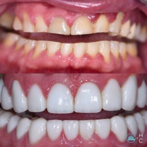 overbite teeth treatment