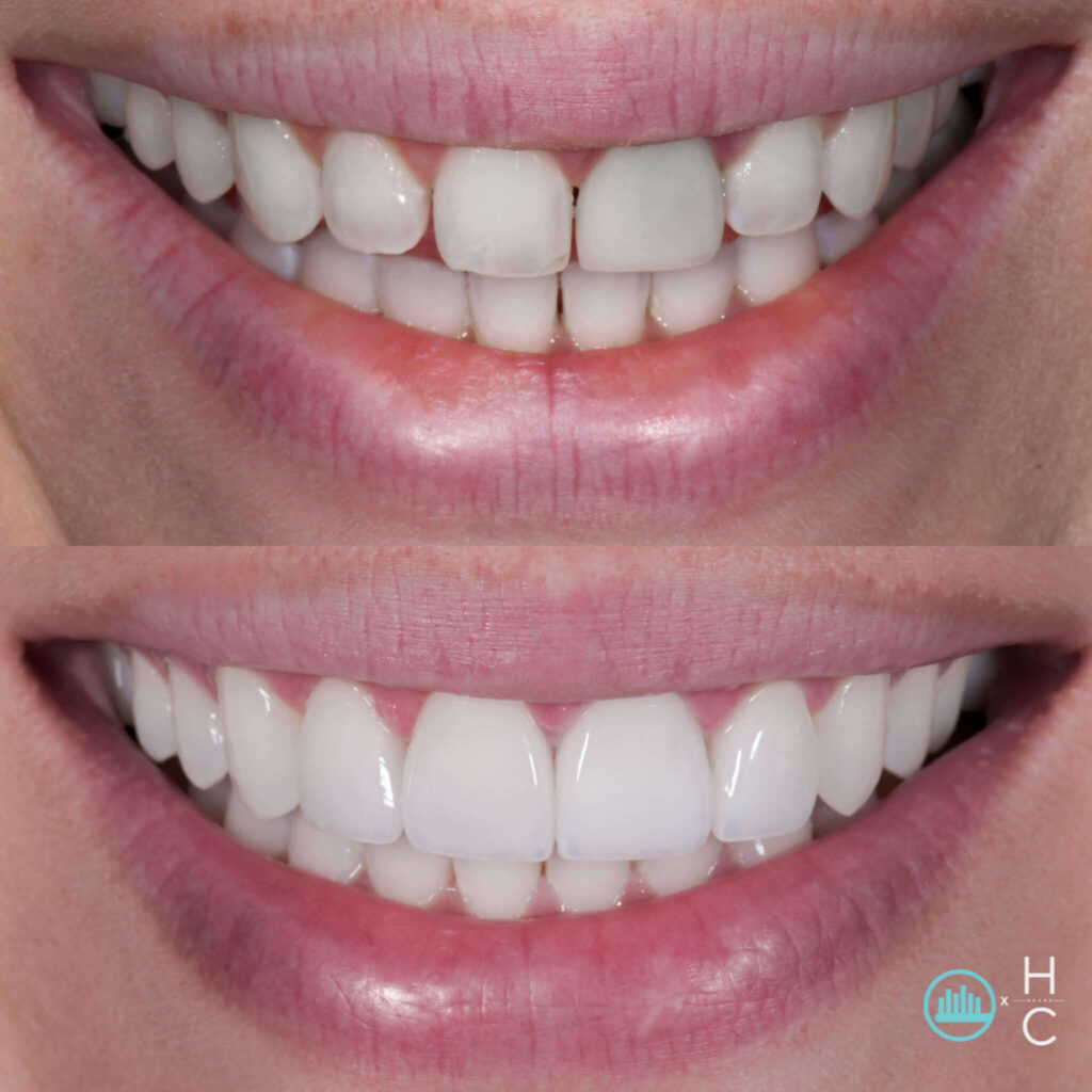 how long does a professional teeth whitening last